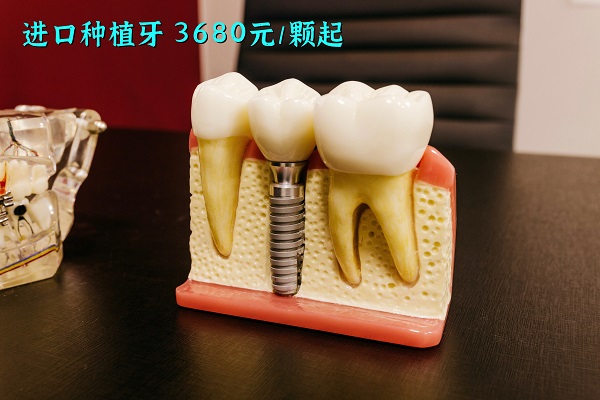 合肥鑲牙的價格表，3種鑲牙方式你pick哪一個？