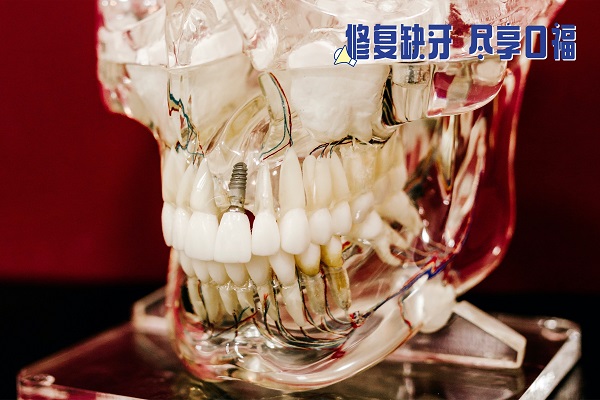 合肥鑲牙的價格表，種植牙/活動假牙/烤瓷牙優缺點大pk！