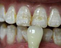 牙釉質發育不全