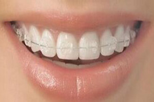 前牙開頜矯正需要注意什么？
