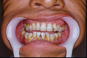 頜紊亂的常見因素是什么呢？