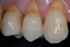 牙齒楔狀缺損是什么意思？