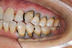 牙齒楔狀缺損如何修復？