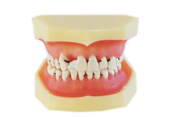 牙齒不齊可分為哪幾類？